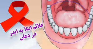 علائم ابتلا به ایدز در دهان