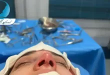 عمل بینی برای بیماران ام اس_ آیا این جراحی می_تواند بی_خطر باشد؟