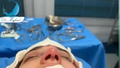 عمل بینی برای بیماران ام اس_ آیا این جراحی می_تواند بی_خطر باشد؟