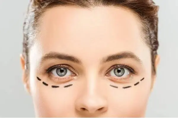 بلفاروپلاستی چیست و چه تغییری در چهره ایجاد میکند؟
