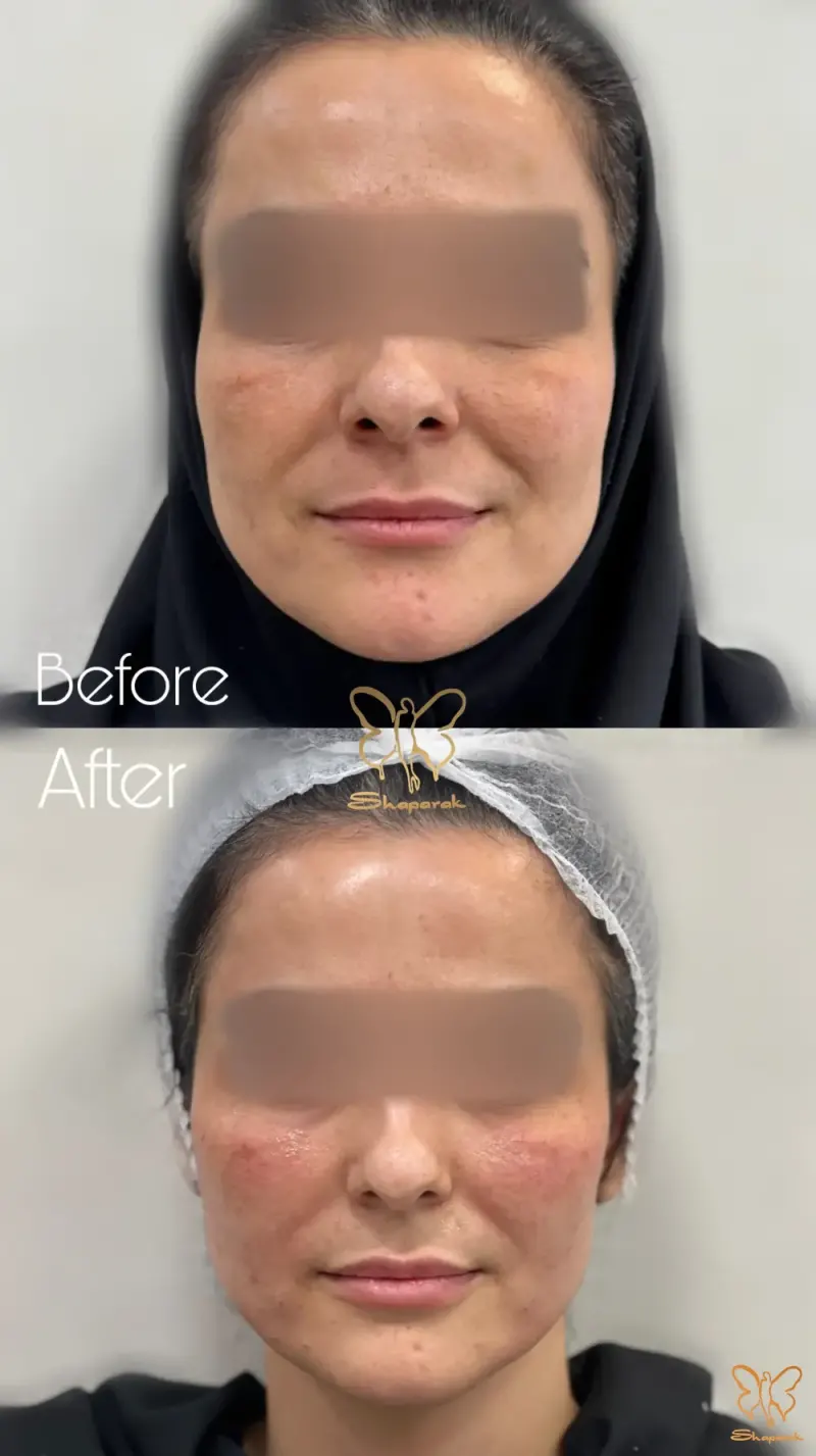 نمونه کار تزریق ژل طبیعی صورت در مشهد