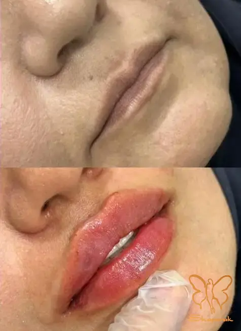 تزریق ژل لب در کلینیک شاپرک طلایی مشهد