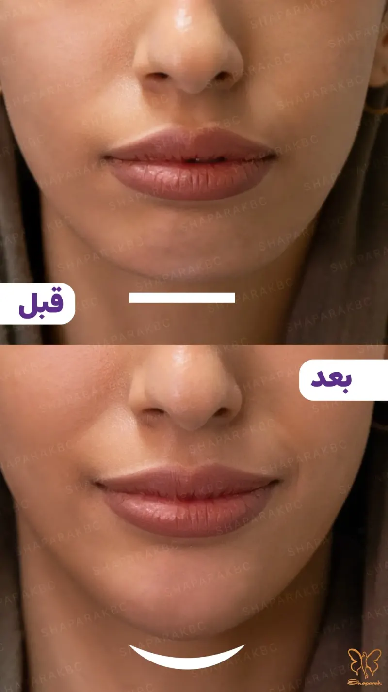 قبل و بعد از تزریق ژل چانه کلینیک شاپرک مشهد